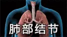 肺结节的源头已找到,烟酒排末位,第1名很多人天天都在做
